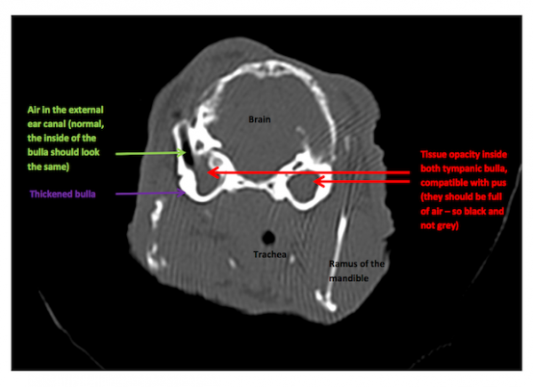 CT scan showing ear infections